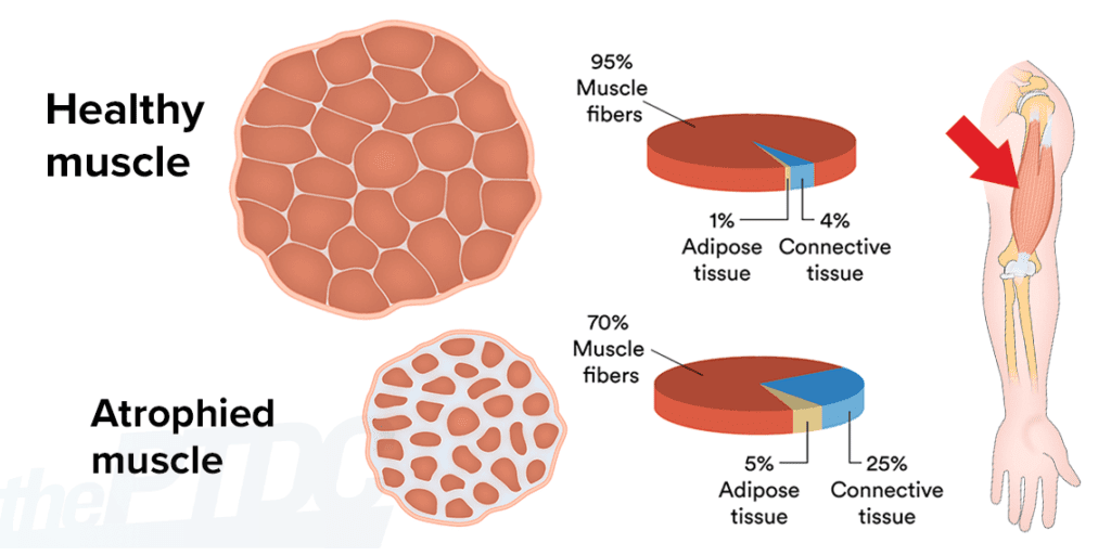 How To Fight Muscle Atrophy After Injury: A Personal Trainer’s Guide