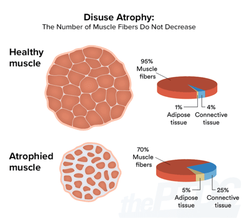 How To Fight Muscle Atrophy After Injury: A Personal Trainer’s Guide