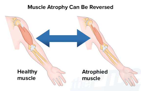 are-you-suffering-from-muscle-atrophy-hubpages